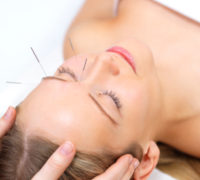 Beautiful young woman with eyes closed receiving acupuncture therapy